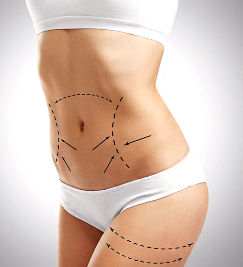 Abdominoplasty